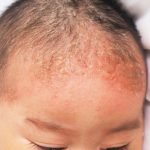 乳児の脂漏性皮膚炎