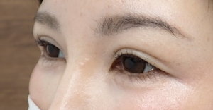 ひらた後4か月ー3 | 大山皮ふ科 形成外科