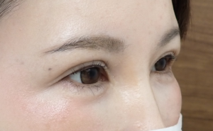 ひらた後4か月ー4 | 大山皮ふ科 形成外科