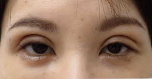 ひらた後1週ー1 | 大山皮ふ科 形成外科