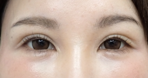 ひらた後4か月ー1 | 大山皮ふ科 形成外科