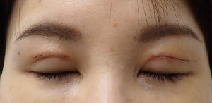 ひらた後1週ー2 | 大山皮ふ科 形成外科