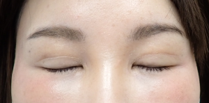 ひらた後4か月ー2 | 大山皮ふ科 形成外科