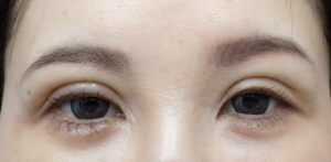 ひらた後1か | 大山皮ふ科 形成外科