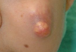 皮膚腫瘍 石灰化上皮腫 毛母腫 | 大山皮ふ科 形成外科