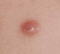 皮膚腫瘍 皮膚線維腫（ひふせんいしゅ） | 大山皮ふ科 形成外科