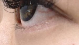 komazawa後3kagetu 1 | 大山皮ふ科 形成外科