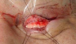 内田オペ3 1 | 大山皮ふ科 形成外科