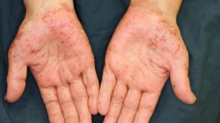 ショウセキン　掌蹠膿疱症　3本セット 医師解説】掌蹠膿疱症の治療を通して考える「ら」と「せ」じゃ大